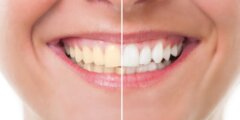6 طرق فعالة لتبييض الأسنان بدون طبيب
