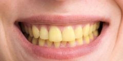 ما سبب اصفرار الأسنان وكيفية علاجها