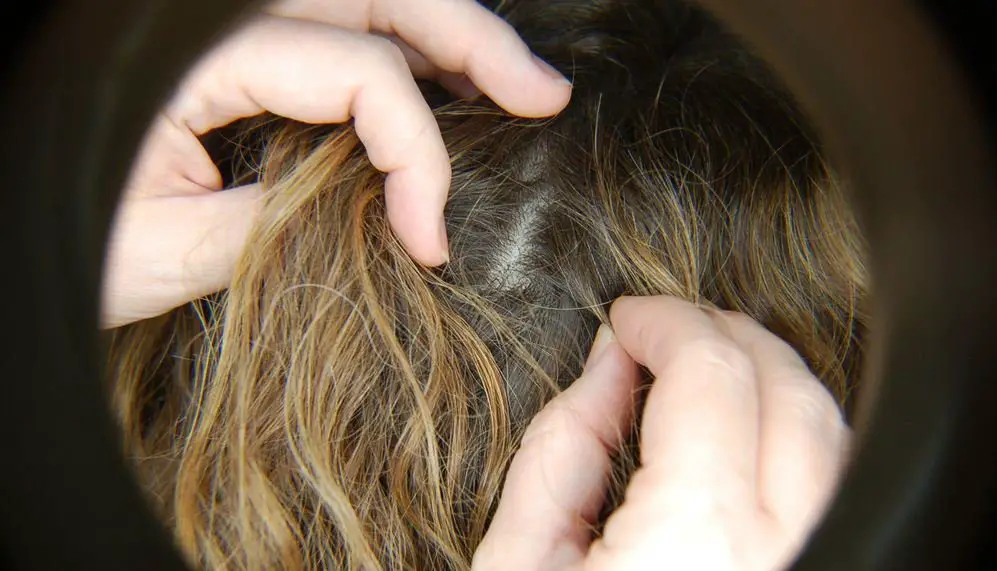 علاج القمل في الشعر بالوصفات الطبيعية الفعالة